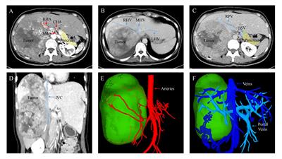 Massive extrapancreatic solid pseudopapillary neoplasm misdiagnosed as hepatic tumor: a case report and literature review